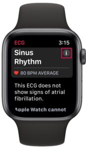 Comment enregistrer un ECG sur Apple Watch